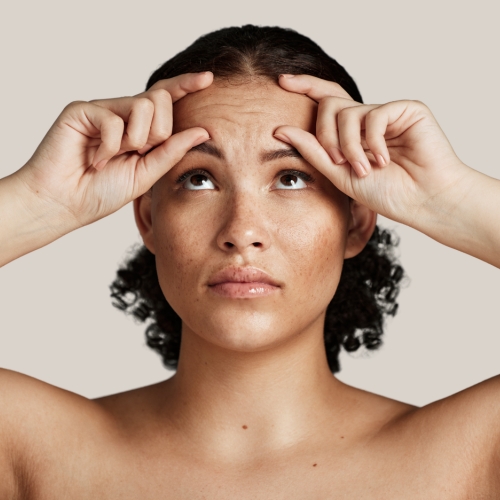 Forehead Lines